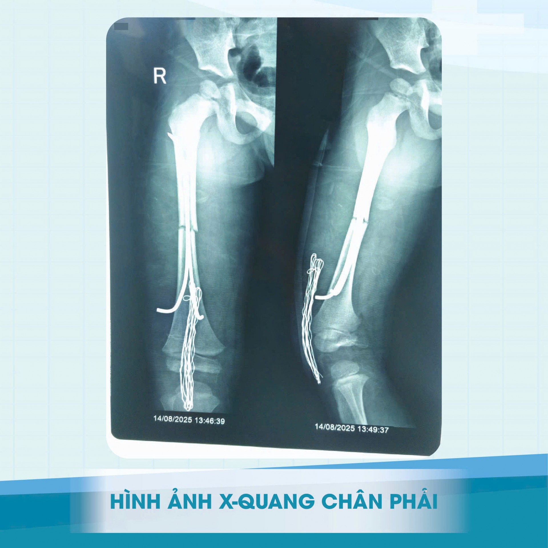 Gia Lai: Tai nạn thương tâm – cảnh báo mất an toàn giao thông với trẻ em Gia Lai: Tai nạn thương tâm – cảnh báo mất an toàn giao thông với trẻ em