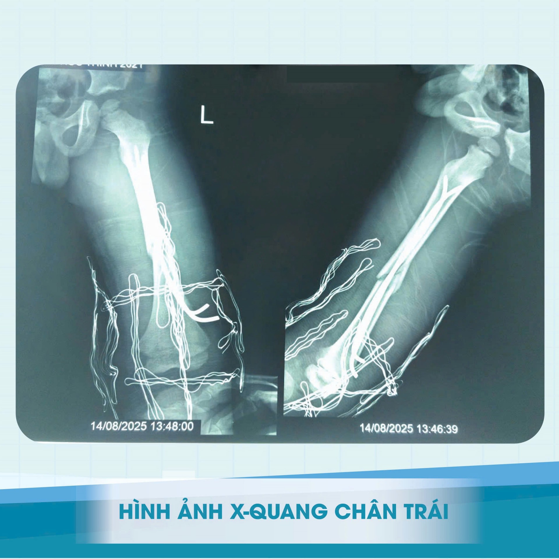 Gia Lai: Tai nạn thương tâm – cảnh báo mất an toàn giao thông với trẻ em Gia Lai: Tai nạn thương tâm – cảnh báo mất an toàn giao thông với trẻ em