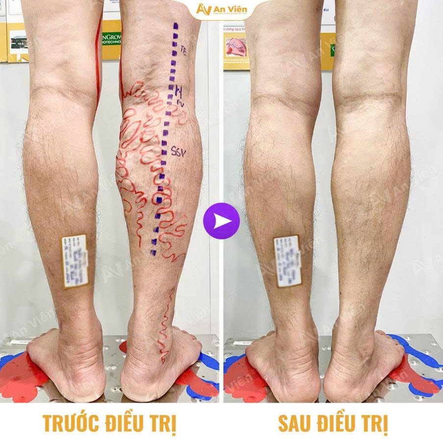 Khám phá phác đồ cá nhân hóa cho bệnh suy giãn tĩnh mạch tại An Viên
