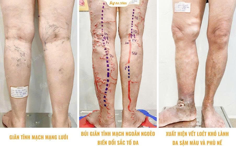 Khám phá phác đồ cá nhân hóa cho bệnh suy giãn tĩnh mạch tại An Viên