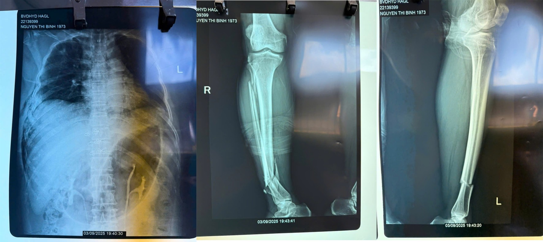 Gia Lai - Sập bồn nước 1.000 lít khiến người phụ nữ bị nguy kịch