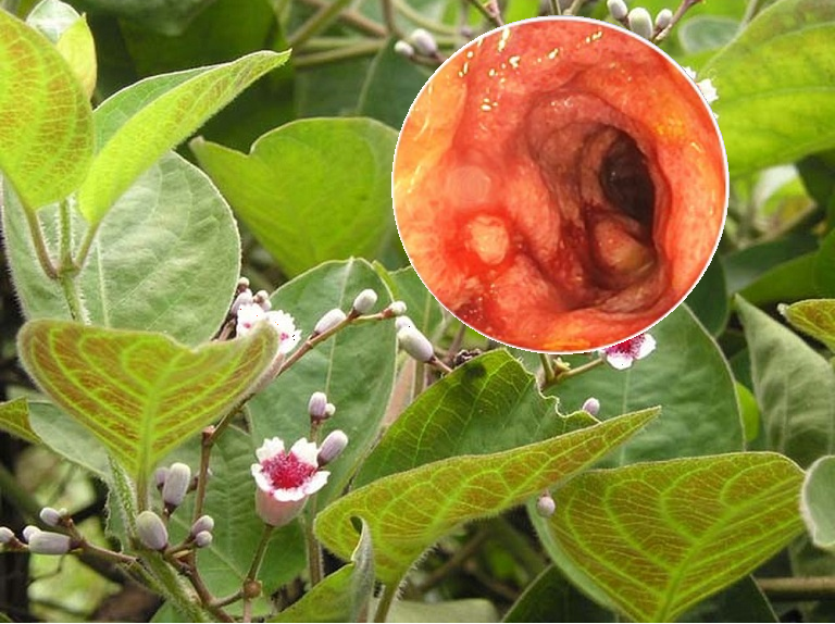Lá mơ chữa bệnh đại tràng mãn tính Lá mơ chữa bệnh đại tràng mãn tính