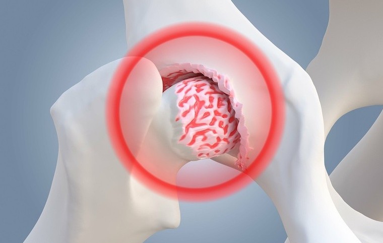 Phát hiện sự liên quan giữa Covid-19 và hoại tử xương