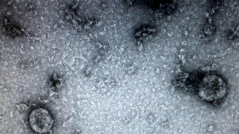 Phát hiện sự liên quan giữa Covid-19 và hoại tử xương