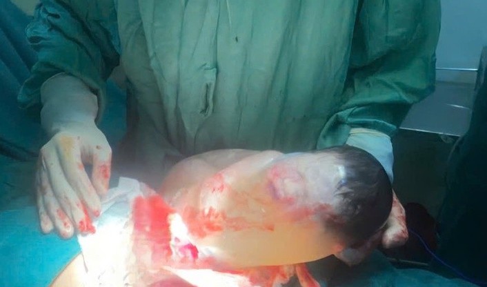 Khoảnh khắc hiếm gặp: Trẻ sơ sinh chào đời còn nguyên trong bọc ối