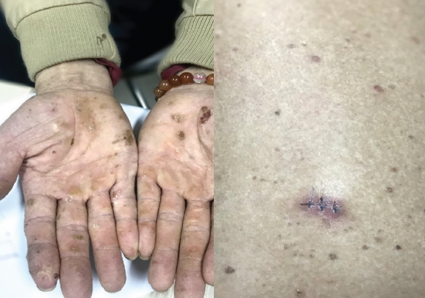 Cảnh báo nhiễm độc thạch tín gây ung thư da từ mỹ phẩm không rõ nguồn gốc