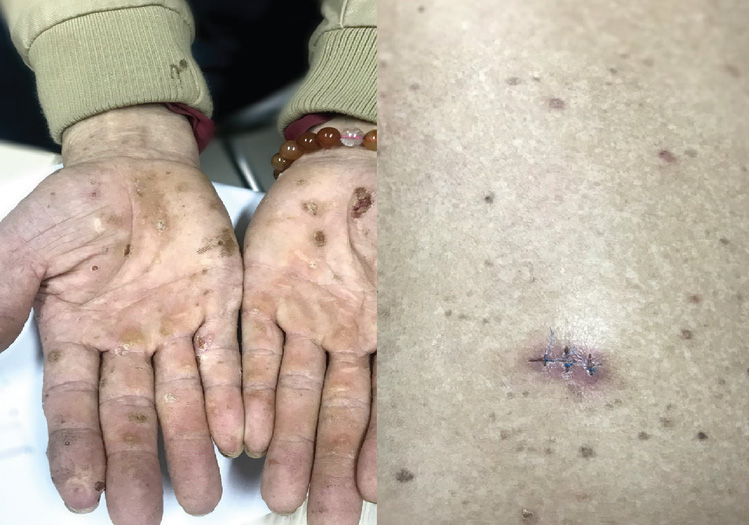 Cảnh báo nhiễm độc thạch tín gây ung thư da từ mỹ phẩm không rõ nguồn gốc