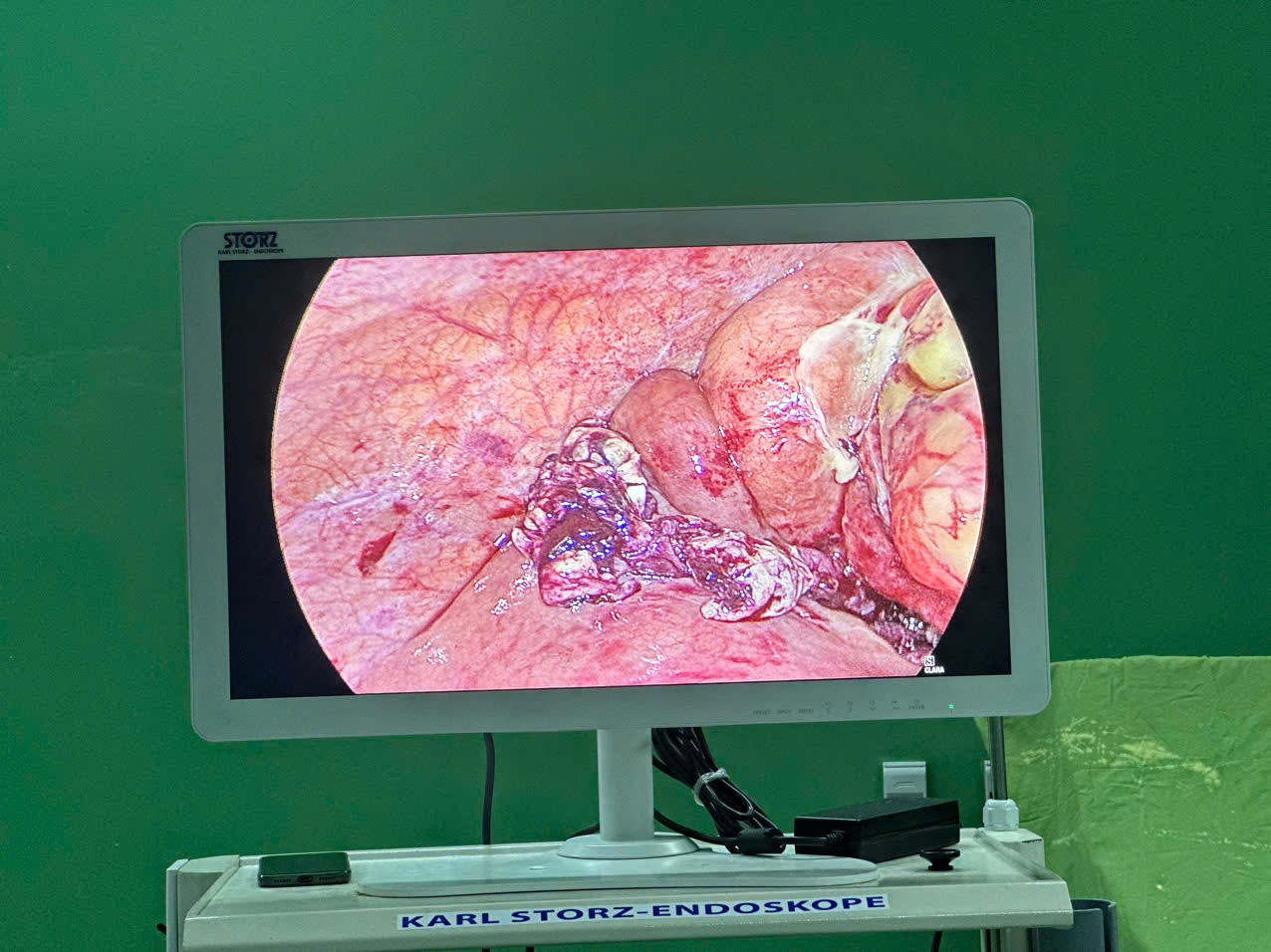 Gia Lai - Phẫu thuật cấp cứu thành công thai phụ áp xe ruột thừa