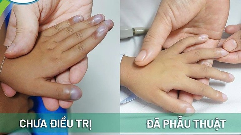 Hành trình hồi sinh trái tim cho bé trai 5 tuổi mắc tứ chứng Fallot