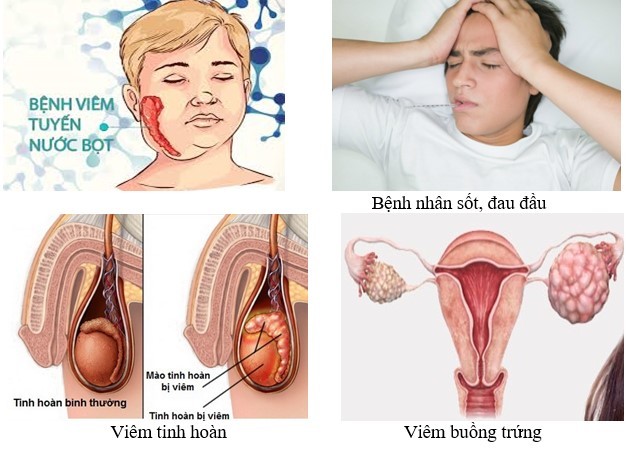 Bệnh Quai bị:  Tổng quan về virus, dịch tễ học, lâm sàng và chiến lược phòng ngừa