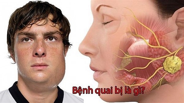 Bệnh Quai bị:  Tổng quan về virus, dịch tễ học, lâm sàng và chiến lược phòng ngừa