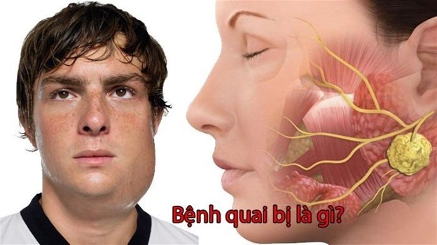 Bệnh Quai bị:  Tổng quan về virus, dịch tễ học, lâm sàng và chiến lược phòng ngừa