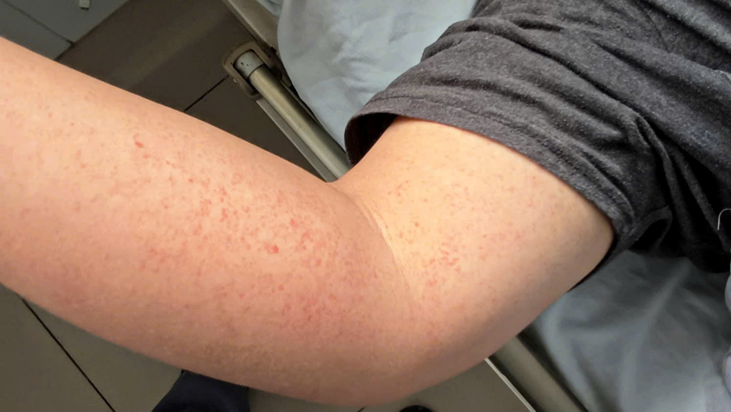 Bất kỳ ai cũng có thể mắc sốt xuất huyết và nguy cơ bệnh nặng