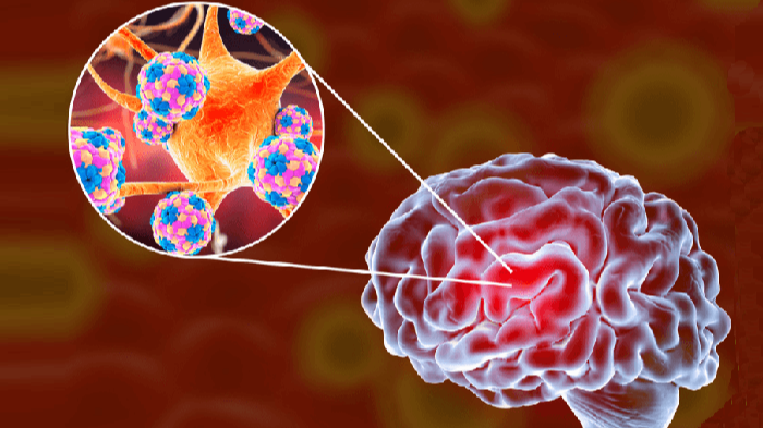 Khoảng 1/4 thanh thiếu niên có thể nhiễm não mô cầu xâm lấn không có triệu chứng