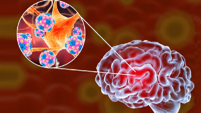 Khoảng 1/4 thanh thiếu niên có thể nhiễm não mô cầu xâm lấn không có triệu chứng