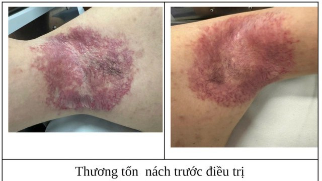 Loại bỏ bệnh da di truyền hiếm gặp nhờ phương pháp điều trị mới