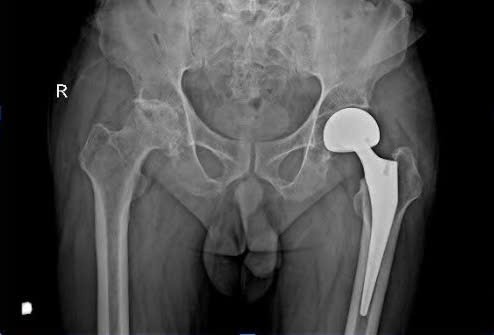 Bệnh viện Lê Văn Việt phẫu thuật thành công ca thay khớp háng lần hai cho bệnh nhân hoại tử chỏm xương đùi