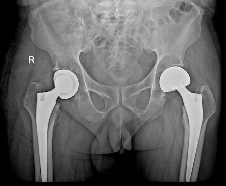 Bệnh viện Lê Văn Việt phẫu thuật thành công ca thay khớp háng lần hai cho bệnh nhân hoại tử chỏm xương đùi
