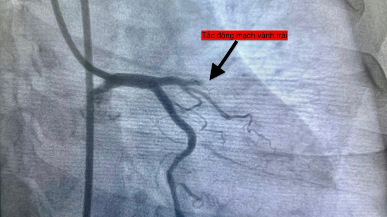 Cảnh báo gia tăng đột ngột ca nhồi máu cơ tim do biến động thời tiết