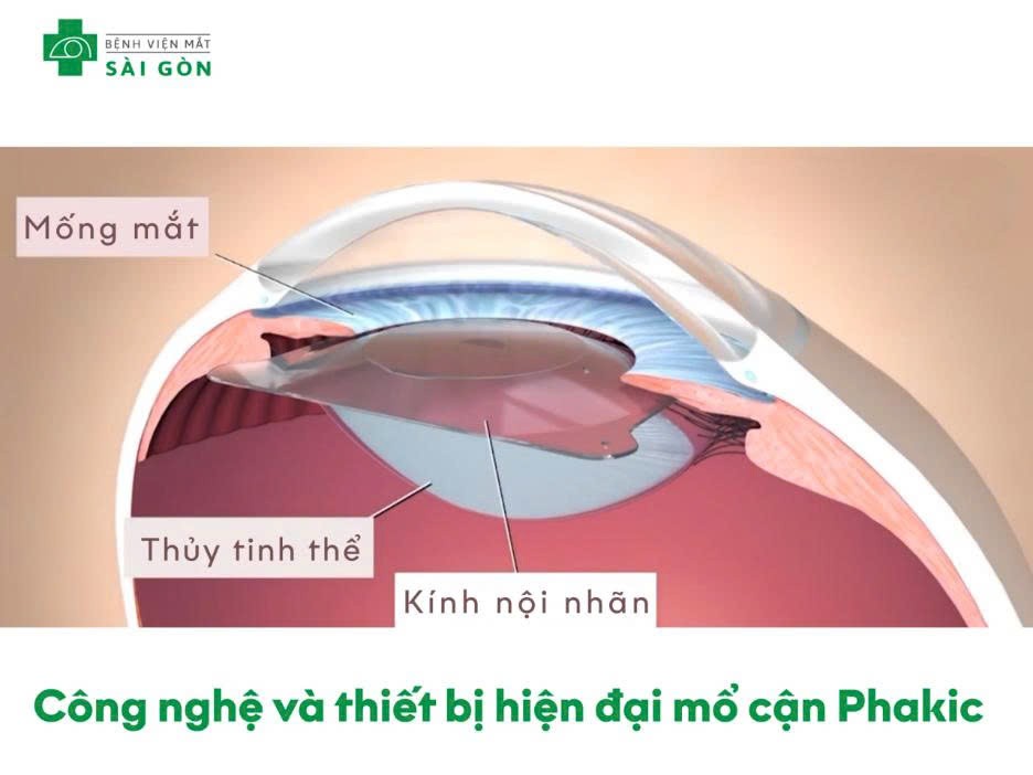Tại sao nên chọn Phakic/Phakic để mổ cận/ loạn thị?