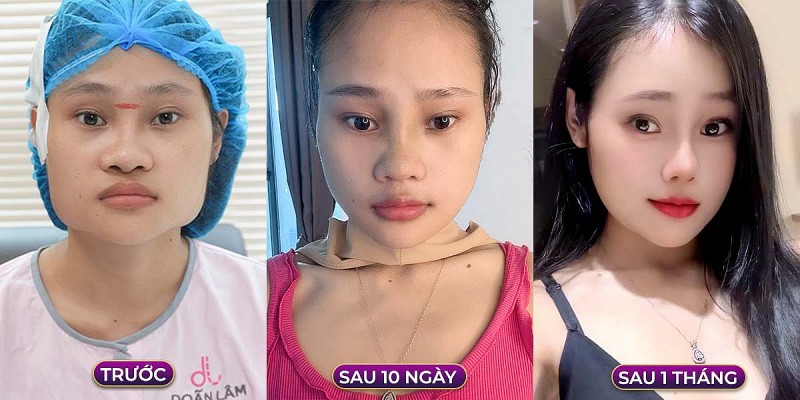 Chỉnh xương hàm mặt – Bí quyết hoàn thiện nhan sắc cùng Bác sĩ Trần Doãn Lâm