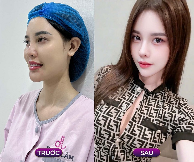 Chỉnh xương hàm mặt – Bí quyết hoàn thiện nhan sắc cùng Bác sĩ Trần Doãn Lâm