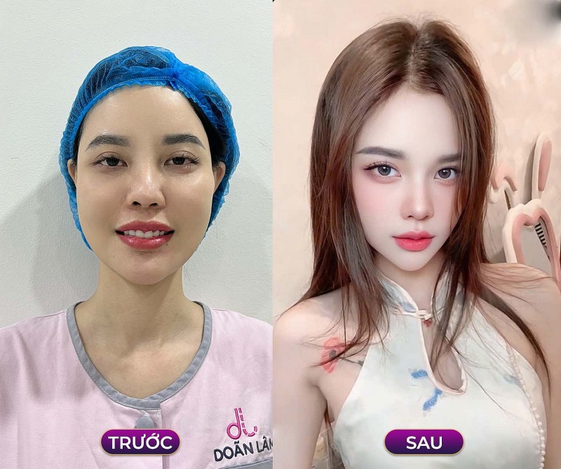 Chỉnh xương hàm mặt – Bí quyết hoàn thiện nhan sắc cùng Bác sĩ Trần Doãn Lâm