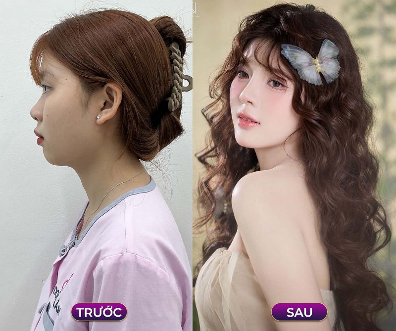 Chỉnh xương hàm mặt – Bí quyết hoàn thiện nhan sắc cùng Bác sĩ Trần Doãn Lâm