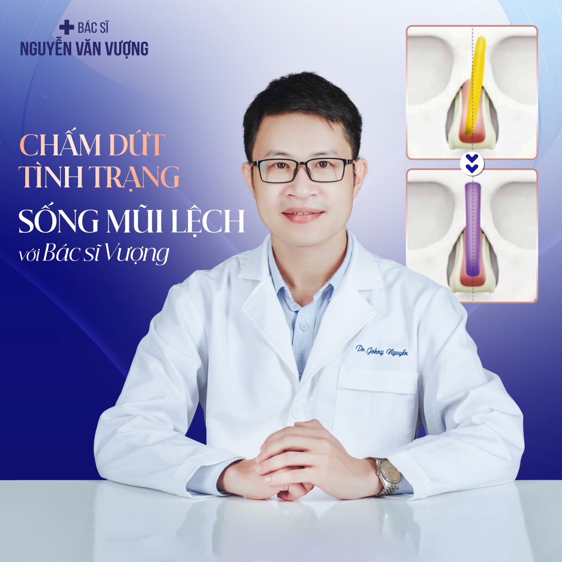 Nâng mũi không còn “đánh cược”: Công nghệ Transform 6D và kỹ thuật cá nhân hóa từ bác sĩ Nguyễn Văn Vượng