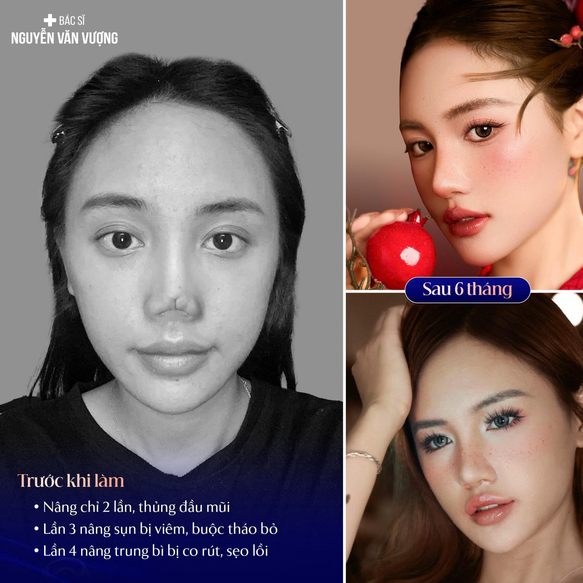 Những ca mũi khó – thử thách lớn, cũng là dấu ấn tay nghề của bác sĩ Nguyễn Văn Vượng