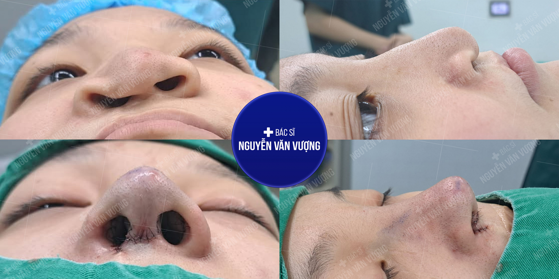 Những ca mũi khó – thử thách lớn, cũng là dấu ấn tay nghề của bác sĩ Nguyễn Văn Vượng