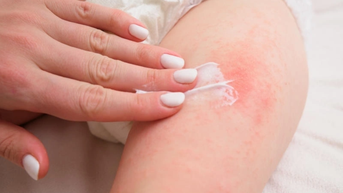 Những lưu ý quan trọng khi dùng tã dán Huggies để ngừa hăm da