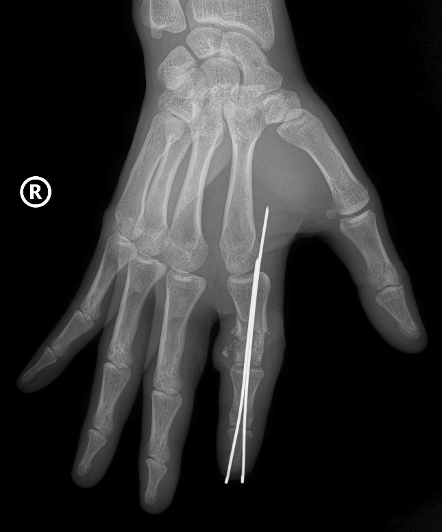 Lần đầu vi phẫu thành công cứu sống ngón tay thủy thủ bị đứt rời sau 25 giờ Lần đầu vi phẫu thành công cứu sống ngón tay thủy thủ bị đứt rời sau 25 giờ