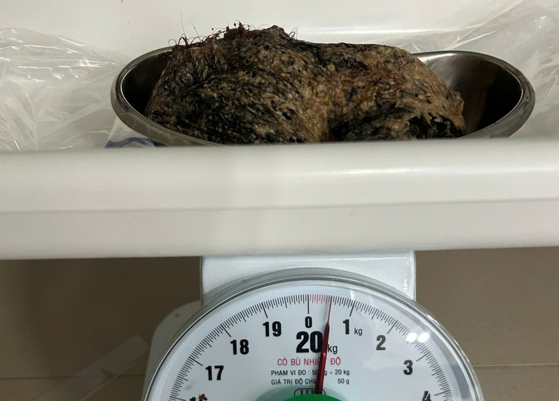 Phẫu thuật lấy búi tóc nặng 500 gram trong dạ dày bé gái 6 tuổi Phẫu thuật lấy búi tóc nặng 500 gram trong dạ dày bé gái 6 tuổi