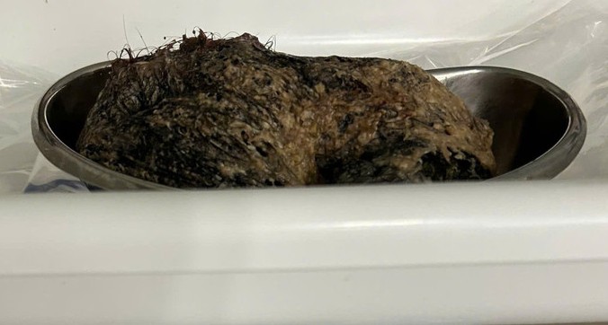 Phẫu thuật lấy búi tóc nặng 500 gram trong dạ dày bé gái 6 tuổi