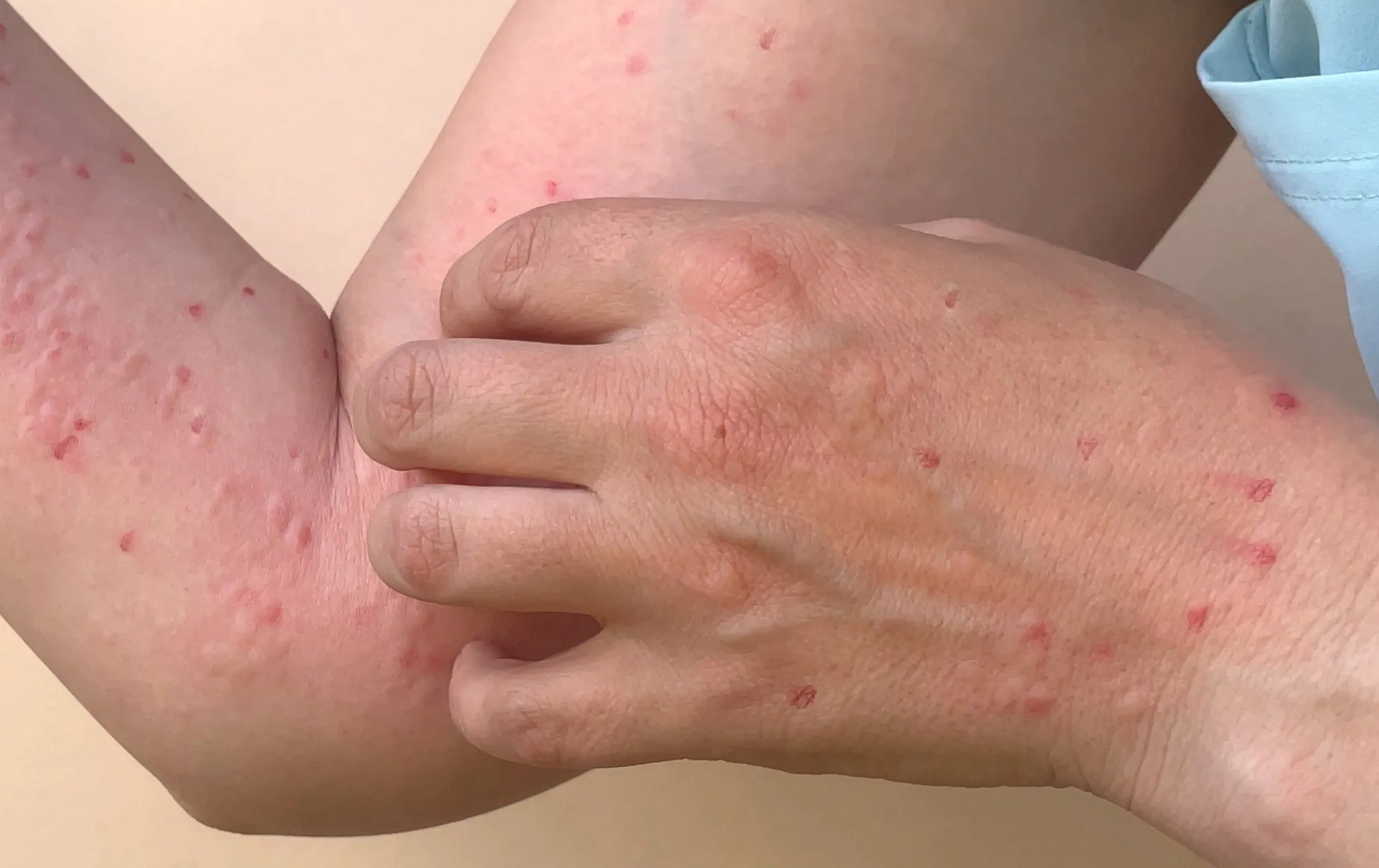 Đồng Nai ghi nhận ca đậu mùa khỉ đầu tiên