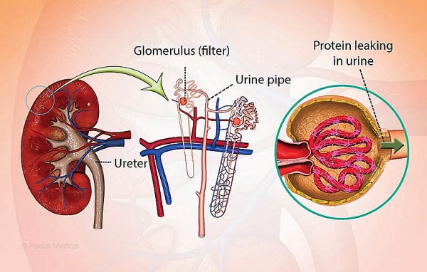Hội chứng thận hư: Cập nhật kiến thức và hướng dẫn điều trị