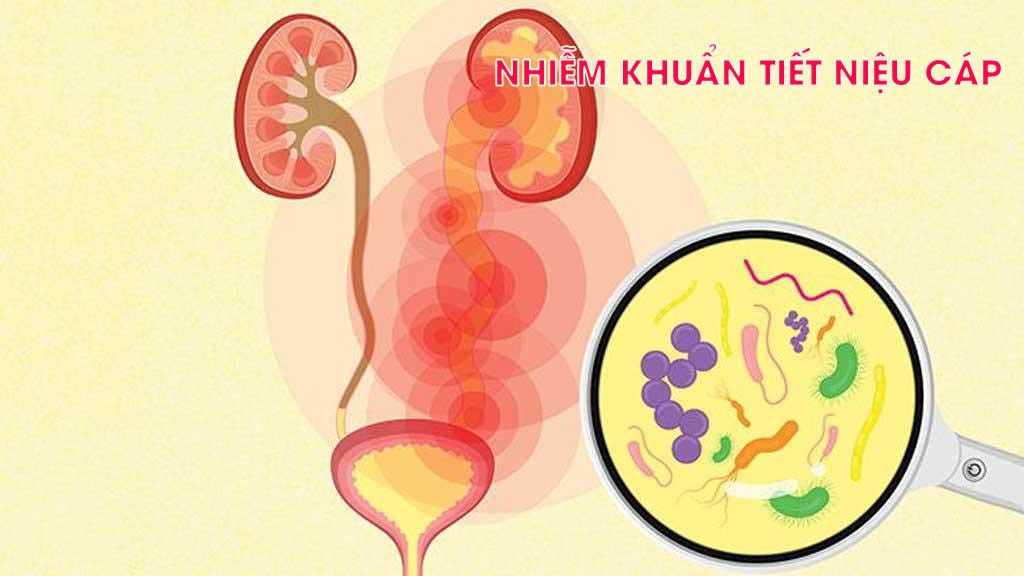 Tổng quan về nhiễm khuẩn tiết niệu cấp: Nguyên nhân, triệu chứng và điều trị