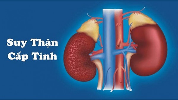 Tổng quan suy thận cấp: Nguyên nhân, chẩn đoán và điều trị