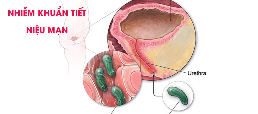 Nhiễm khuẩn Tiết niệu mạn