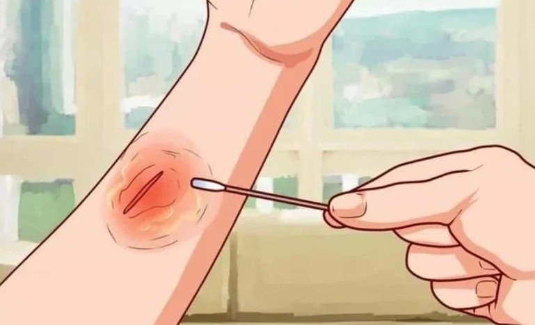 Nhiều ca uốn ván nguy hiểm chỉ từ một vết thương nhỏ