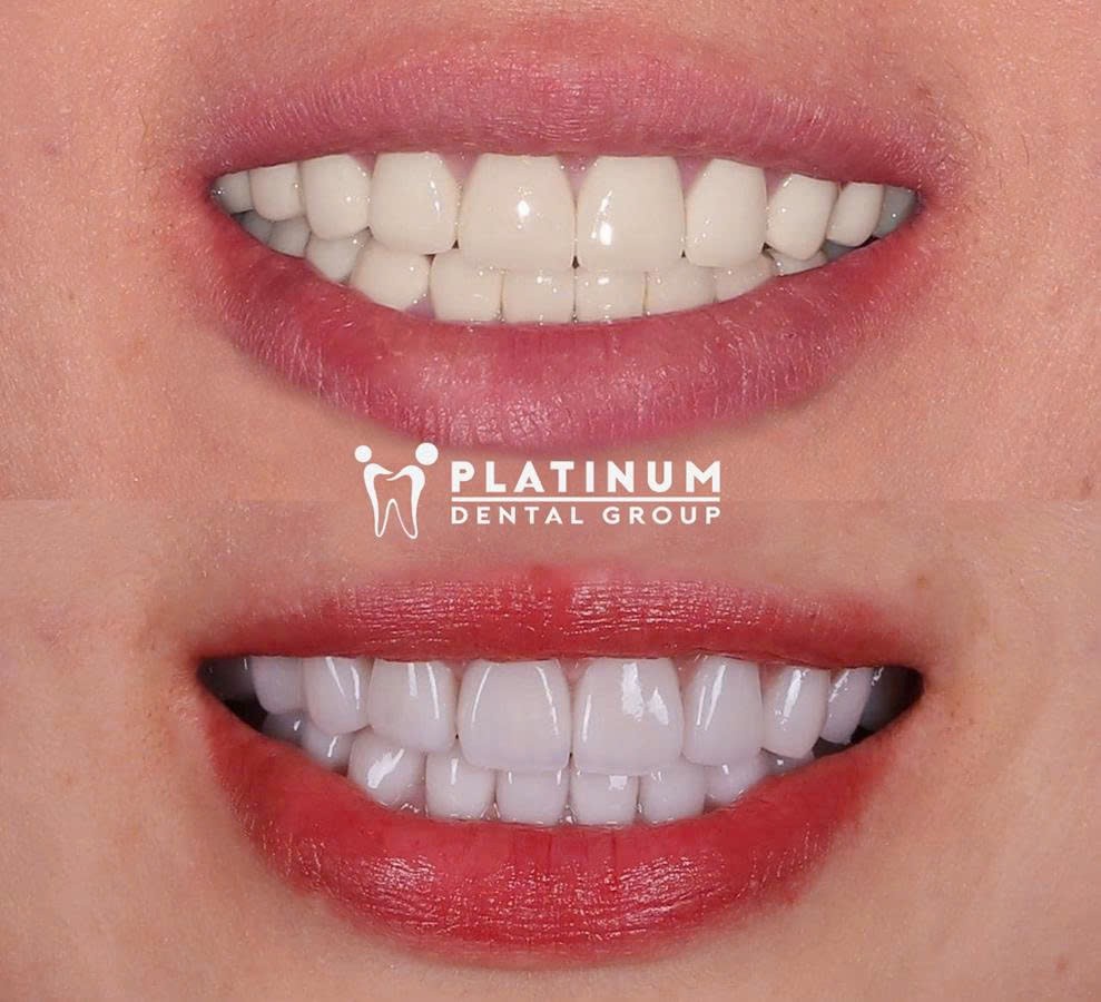 Bọc răng sứ: Chọn giá hay chọn bác sĩ? Nỗi băn khoăn của nhiều người Việt