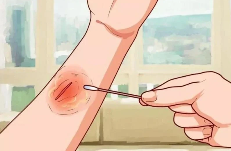 Nhiều ca uốn ván nguy hiểm chỉ từ một vết thương nhỏ