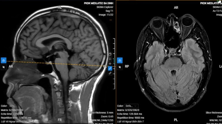 Cảnh báo bệnh lý thần kinh, hô hấp vào mùa lạnh Cảnh báo bệnh lý thần kinh, hô hấp vào mùa lạnh