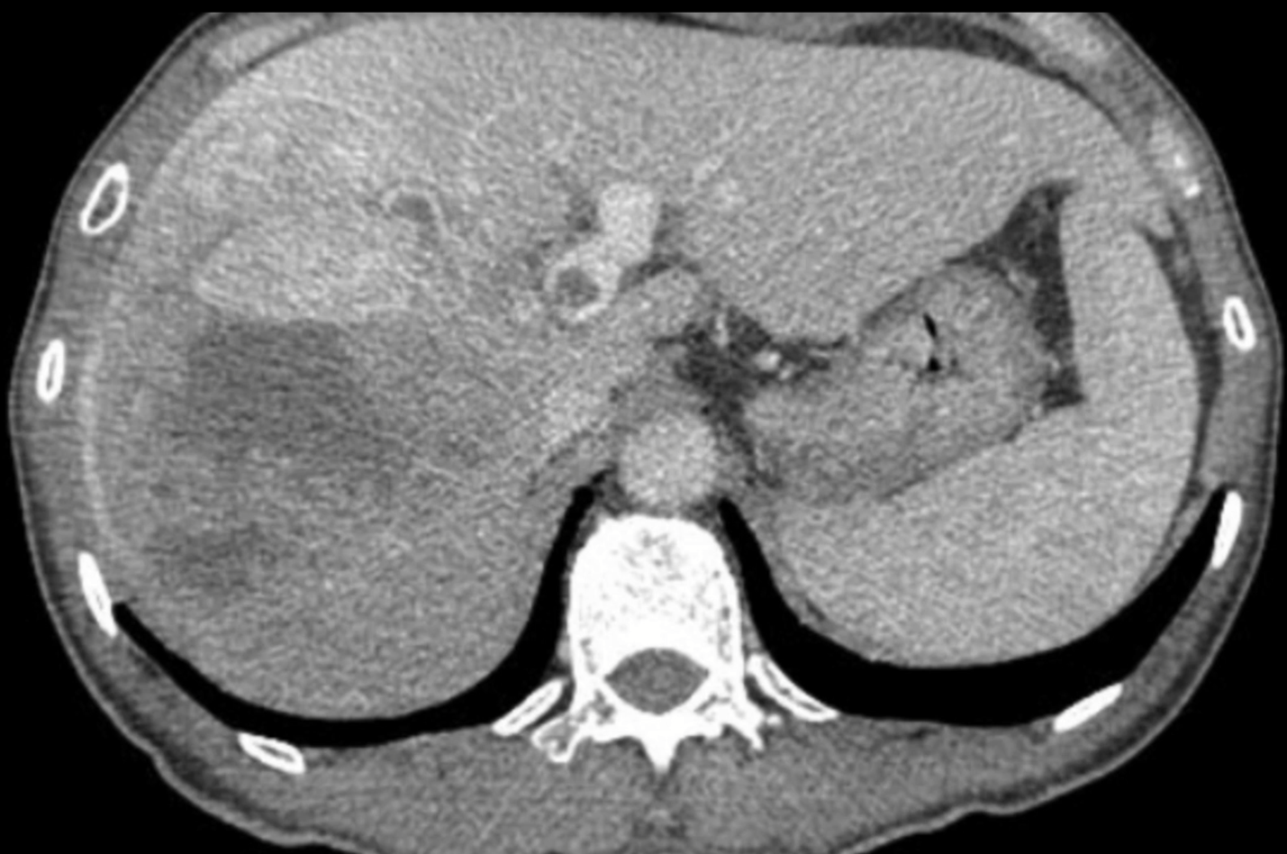 Bệnh viện Việt Đức: Điều trị đa mô thức kết hợp phẫu thuật giúp bệnh nhân ung thư gan giai đoạn muộn vượt qua lằn ranh sinh tử Bệnh viện Việt Đức: Điều trị đa mô thức kết hợp phẫu thuật giúp bệnh nhân ung thư gan giai đoạn muộn vượt qua lằn ranh sinh tử