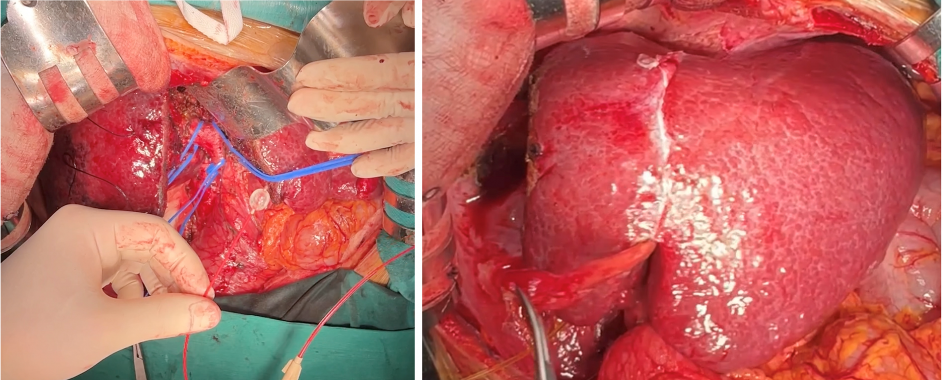 Bệnh viện Việt Đức: Điều trị đa mô thức kết hợp phẫu thuật giúp bệnh nhân ung thư gan giai đoạn muộn vượt qua lằn ranh sinh tử Bệnh viện Việt Đức: Điều trị đa mô thức kết hợp phẫu thuật giúp bệnh nhân ung thư gan giai đoạn muộn vượt qua lằn ranh sinh tử