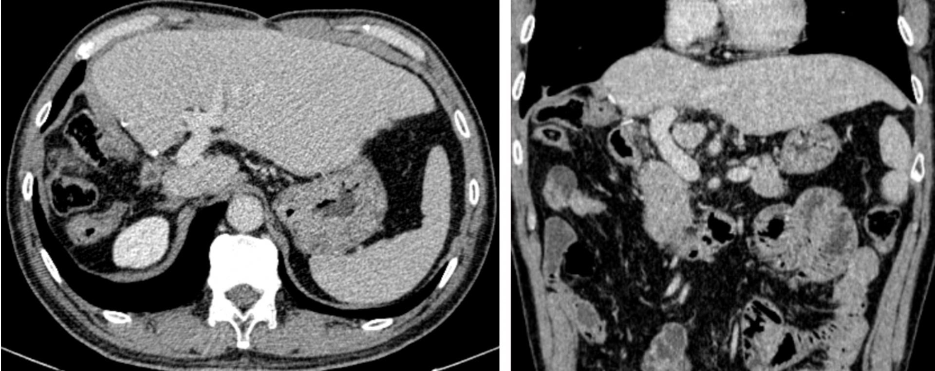 Bệnh viện Việt Đức: Điều trị đa mô thức kết hợp phẫu thuật giúp bệnh nhân ung thư gan giai đoạn muộn vượt qua lằn ranh sinh tử Bệnh viện Việt Đức: Điều trị đa mô thức kết hợp phẫu thuật giúp bệnh nhân ung thư gan giai đoạn muộn vượt qua lằn ranh sinh tử