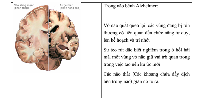 Suy giảm trí nhớ của người cao tuổi: Thực trạng và giải pháp bảo vệ sức khỏe não bộ tăng cường trí nhớ bằng y học cổ truyền