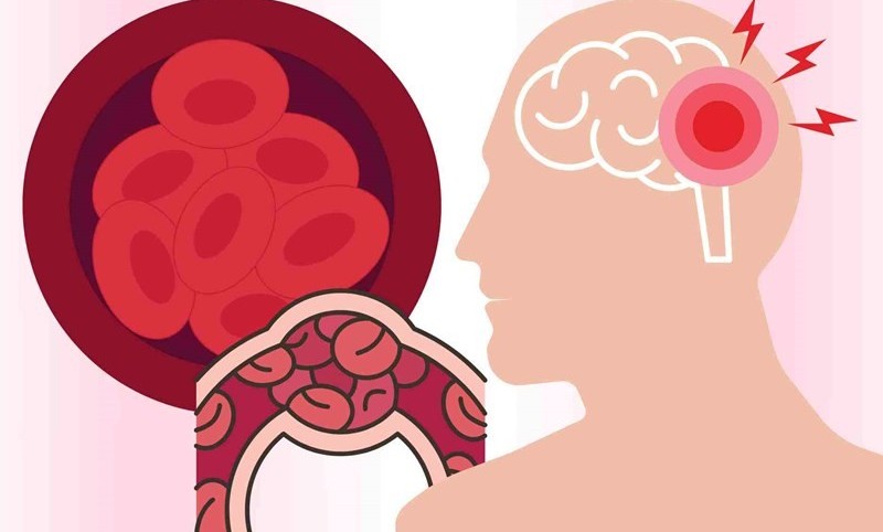 Nâng cao chất lượng chăm sóc và điều trị người bệnh đột quỵ tại Việt Nam