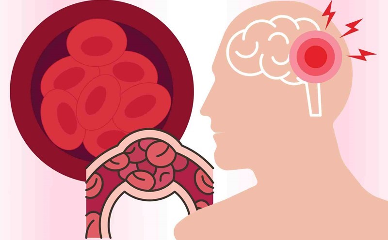 Nâng cao chất lượng chăm sóc và điều trị người bệnh đột quỵ tại Việt Nam